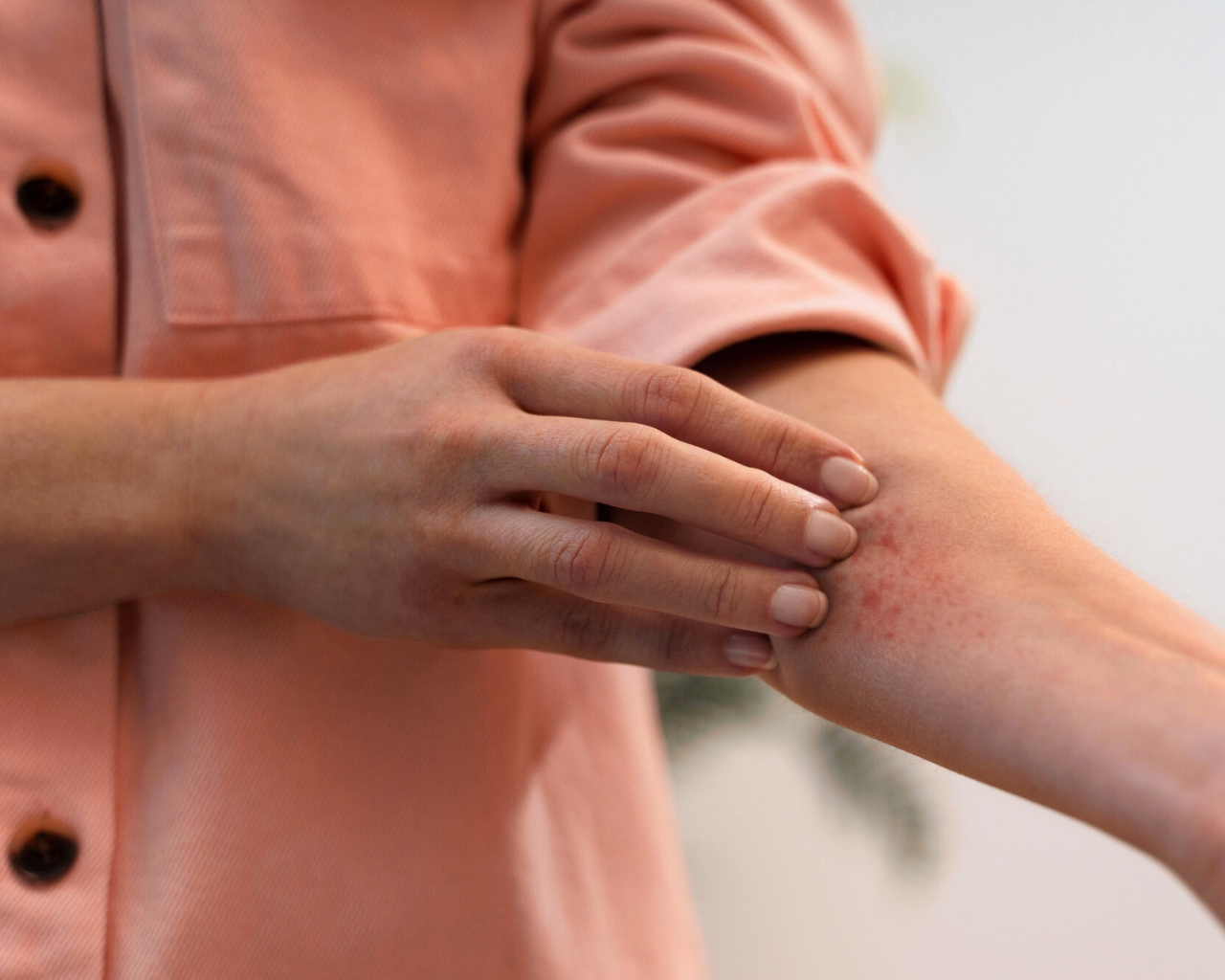 Verano sin riesgos: cómo actuar ante una picadura